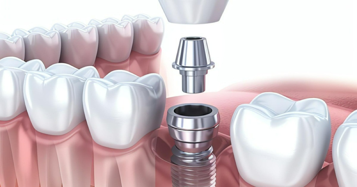 Quelle est la cause la plus courante d’échec d’un implant ?