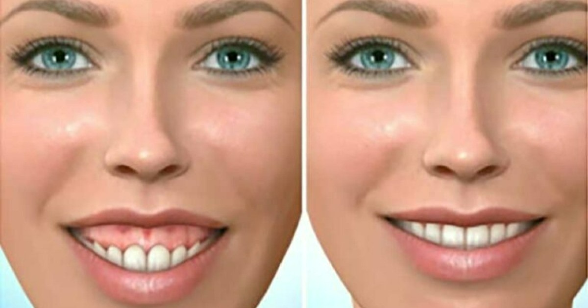 Popular Gummy Smile Correction Options