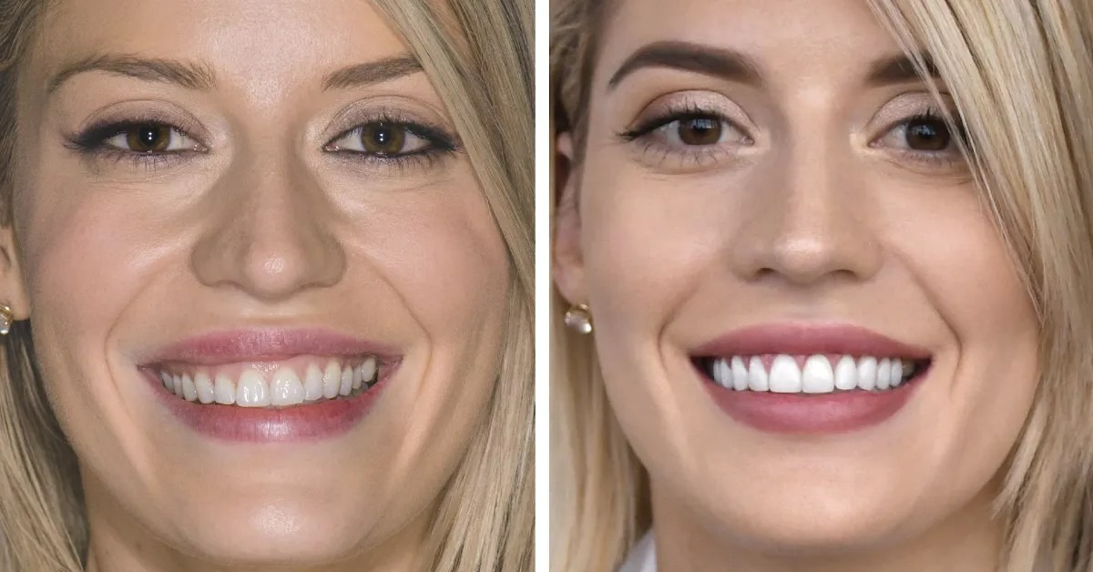 Que sont les dents inclinées et comment les corriger ?